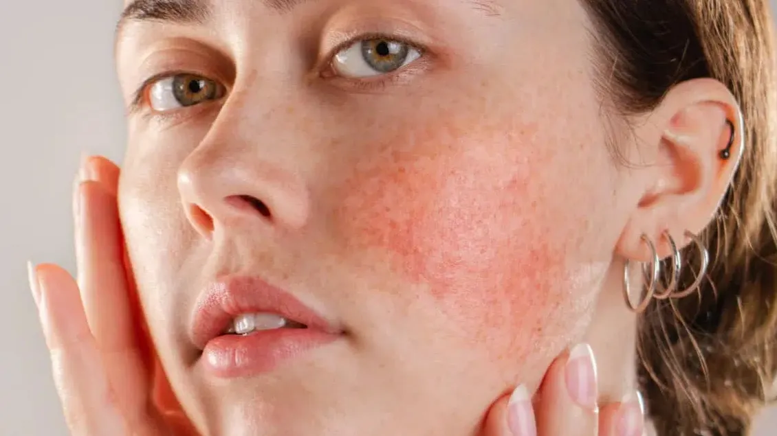 Hipersensitif pada Kulit: Mengapa Mudah Iritasi dan Solusi Ampuh