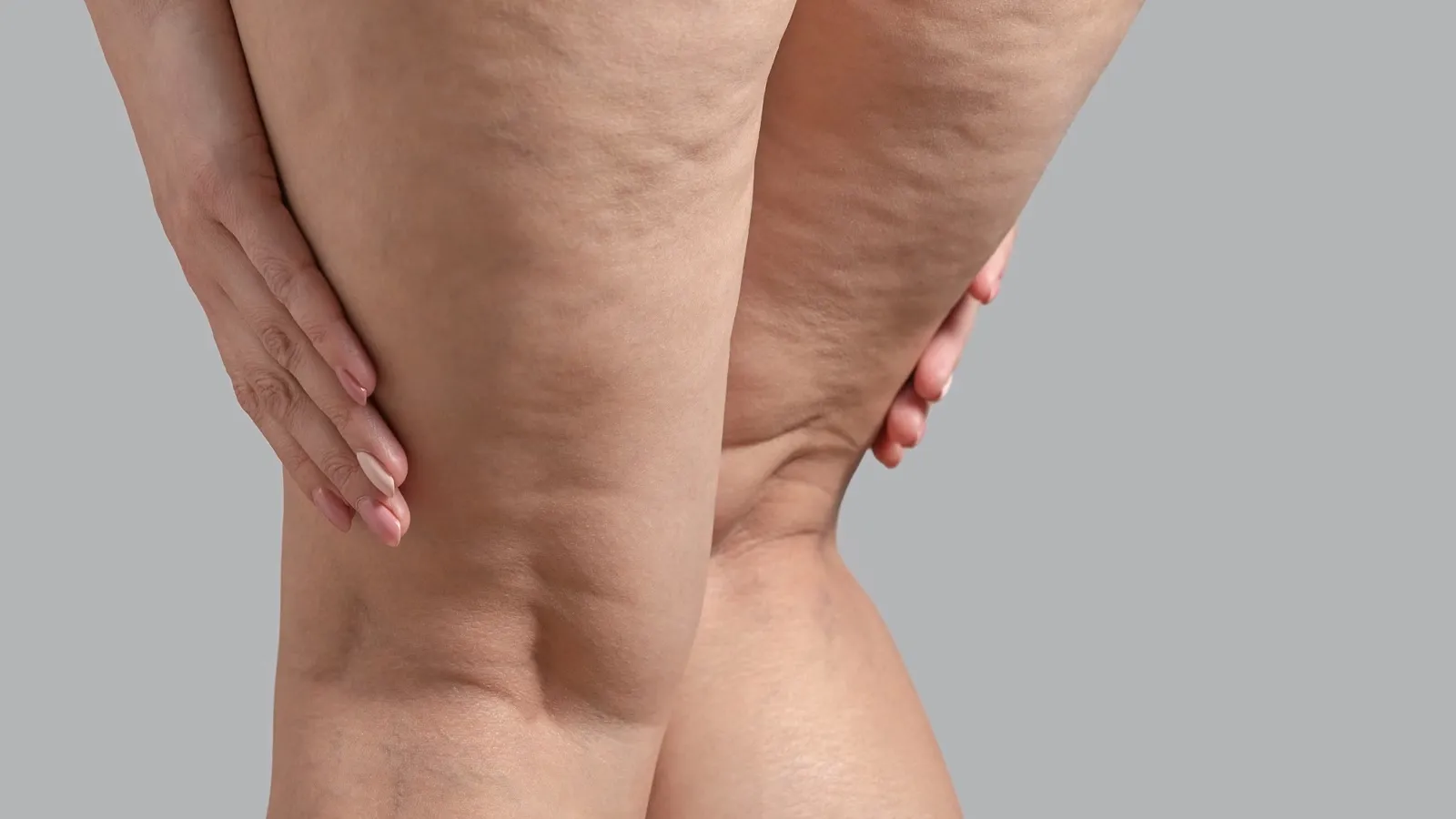 Apa Itu Lipedema? Gejala, Penyebab, dan Cara Mengatasinya