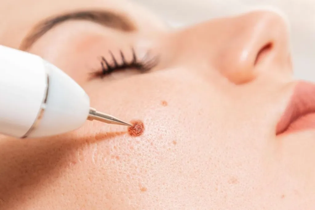 Cauter Adalah Solusi Ampuh: Hilangkan Kutil & Skin Tag Secara Instan