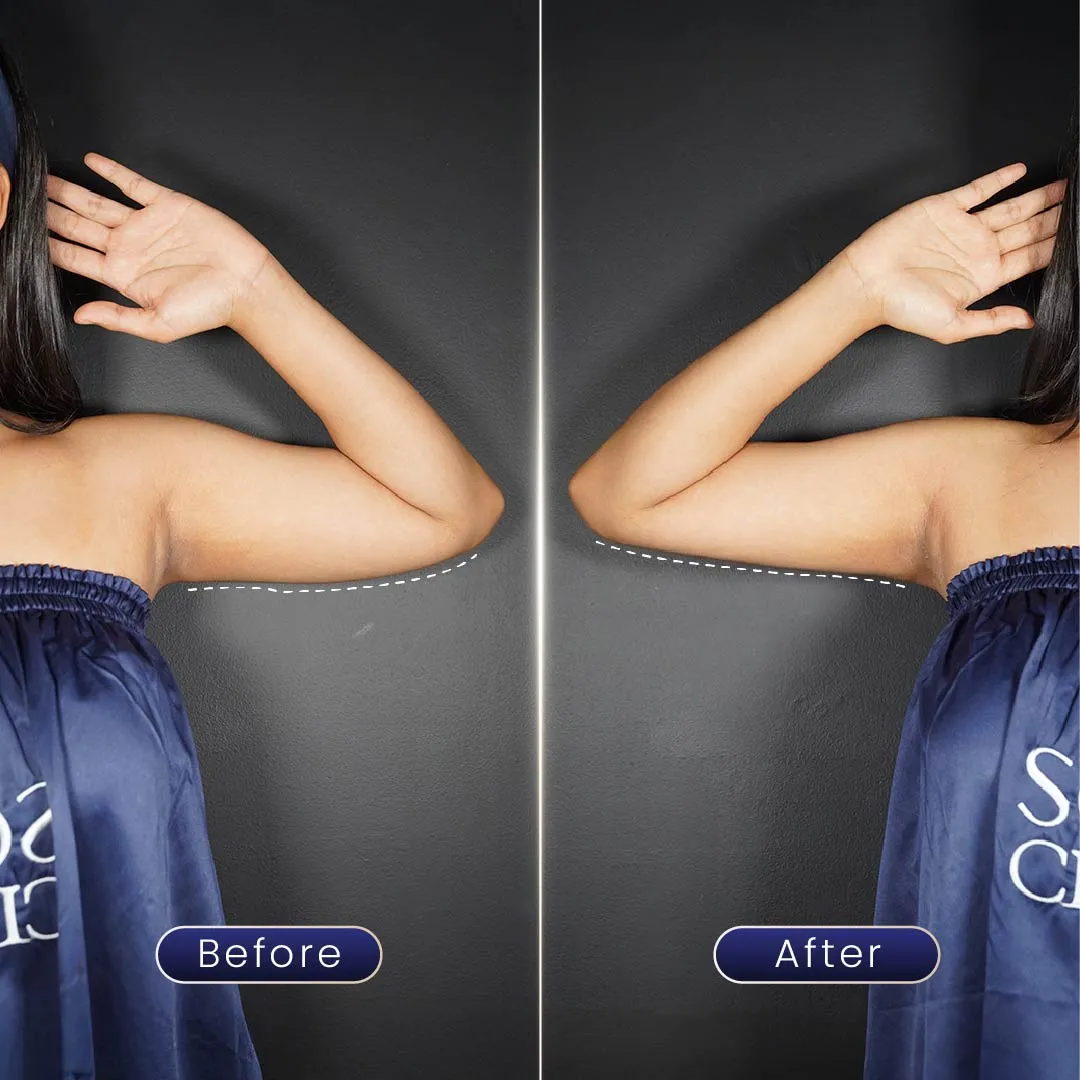 before & after lengan setelah program slimming