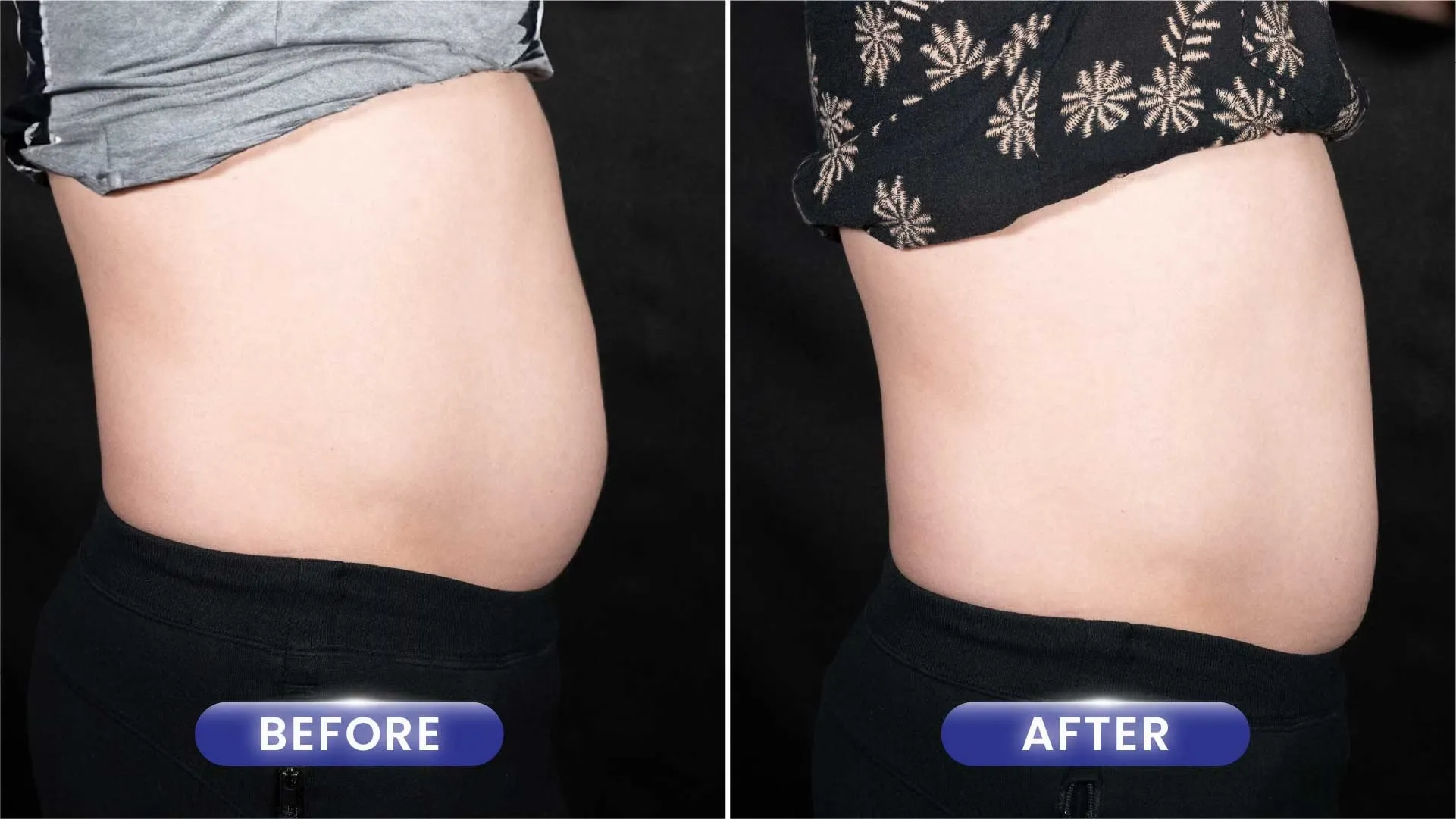 Before After Ultrasculpt Perut Samping