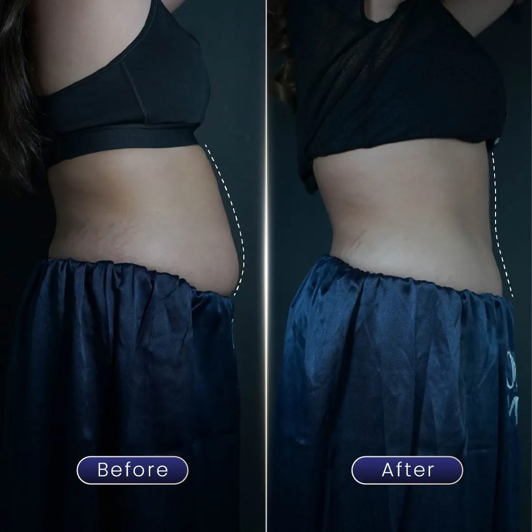before & after perut setelah program slimming