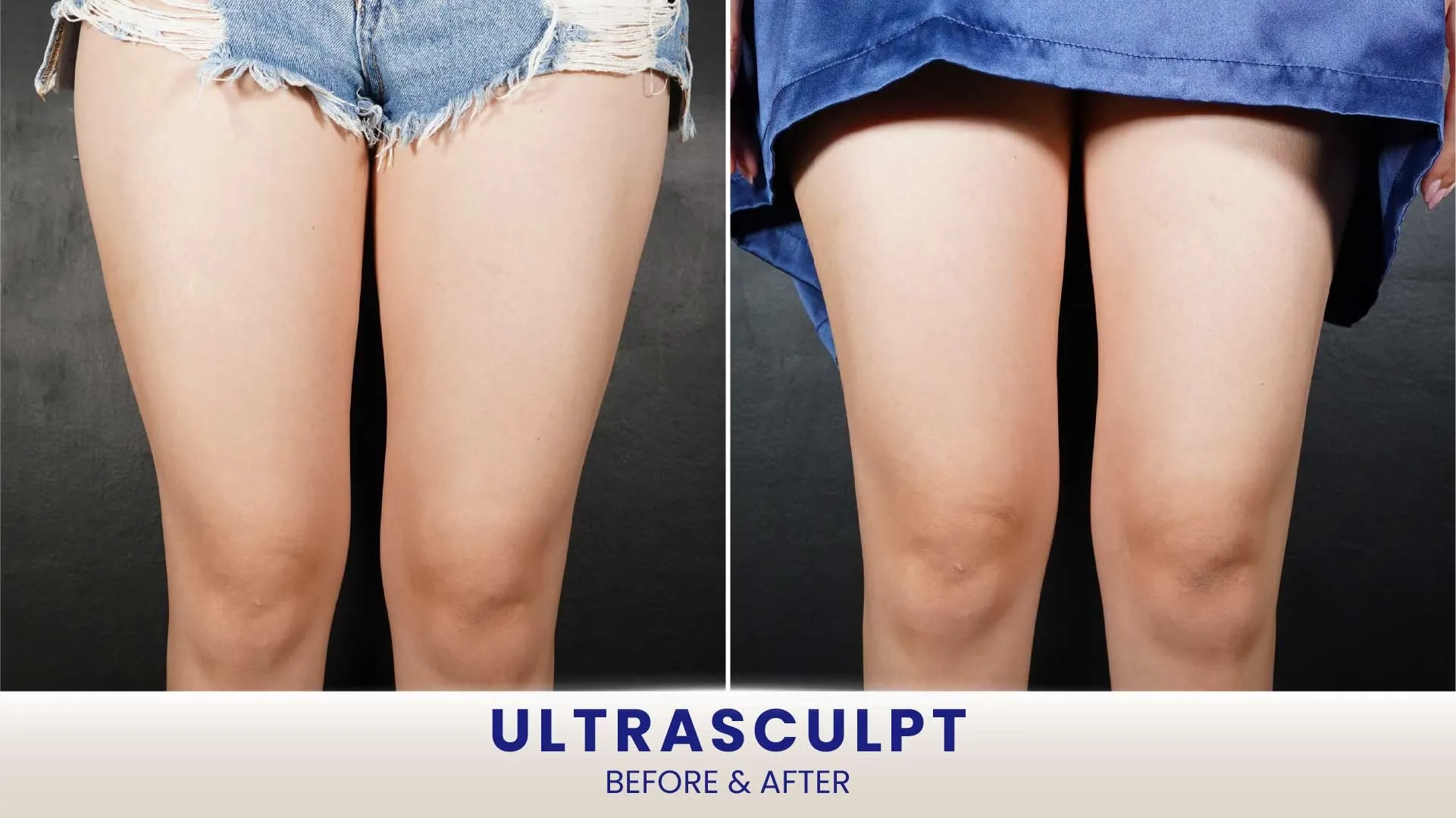 Before After Ultrasculpt Paha