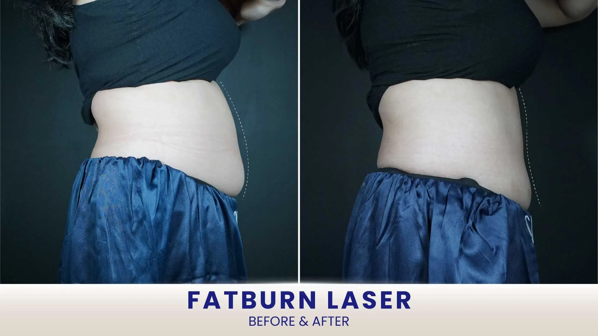 Before After Fatburn Laser