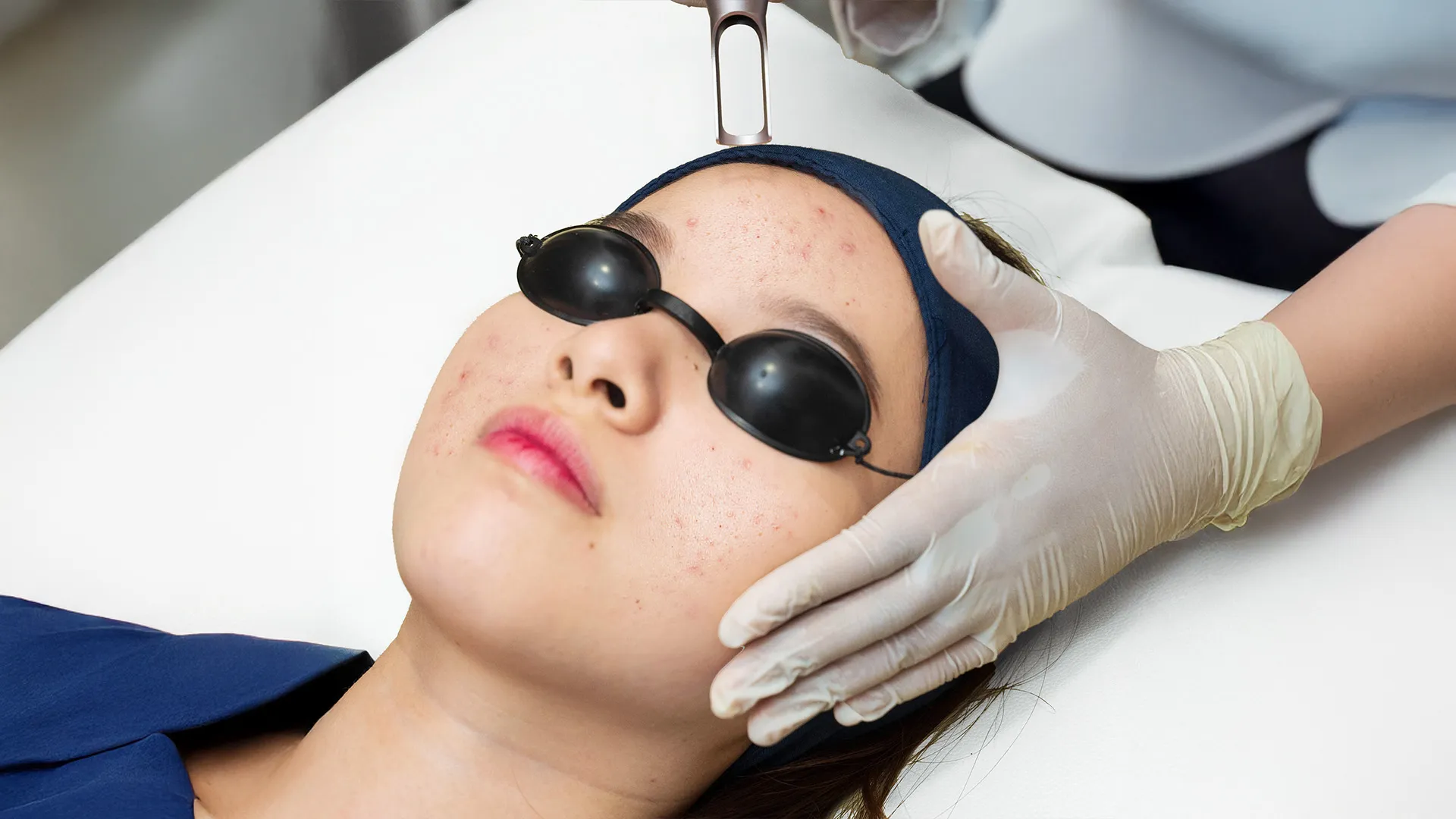 Acne Treatment