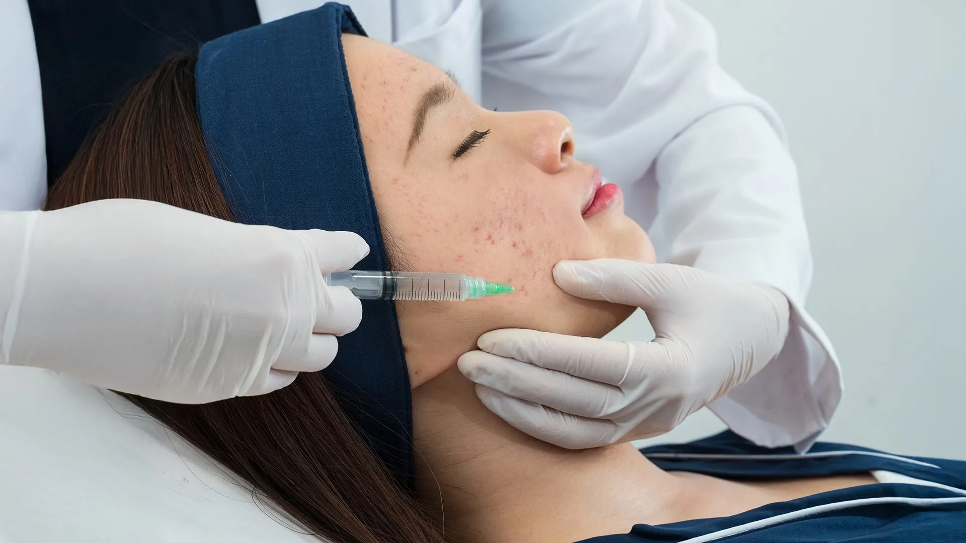 Acne Treatment