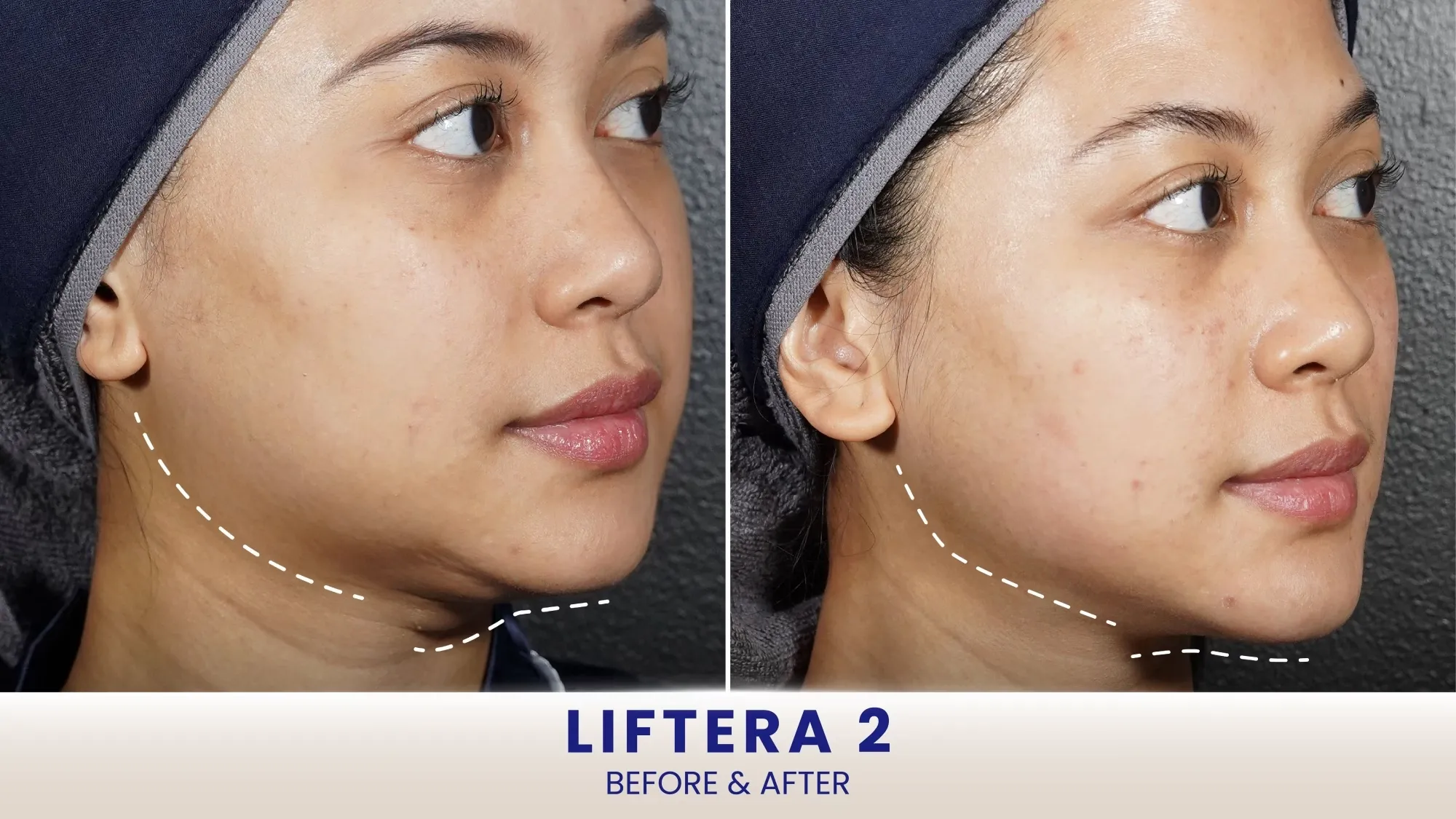 Before After Liftera HIFU
