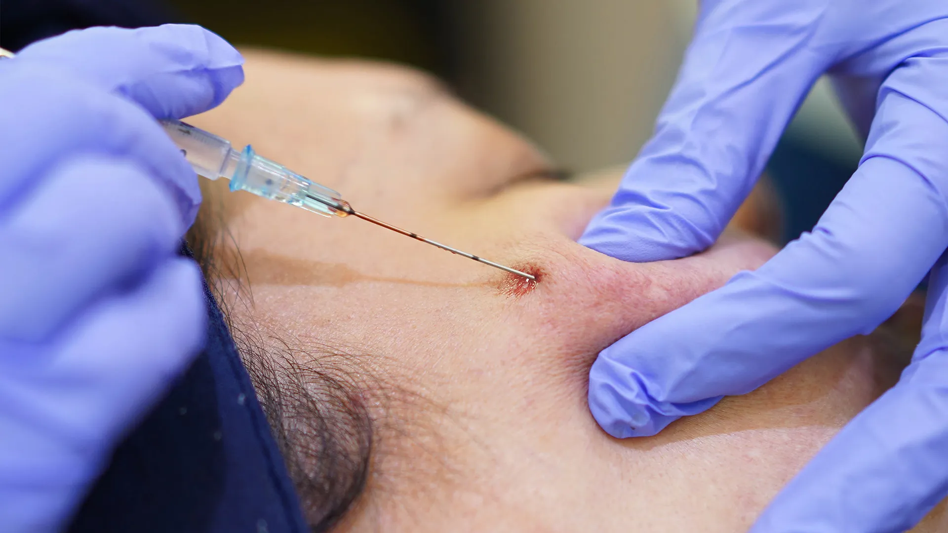 Subcision Treatment Sozo Skin Clinic