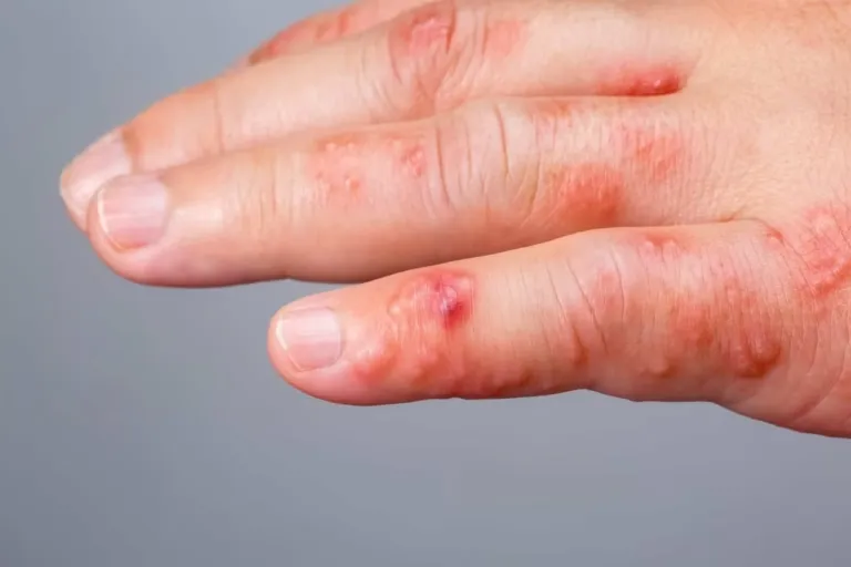 Cara Membunuh Kutu Scabies Tuntas hingga Telur, Bukan Cuma Gatal