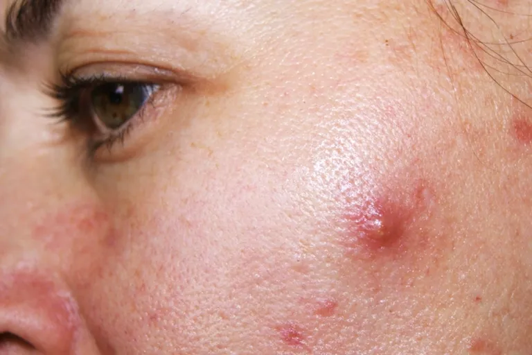 7 Penyebab Jerawat Aktif yang Sering Disepelekan