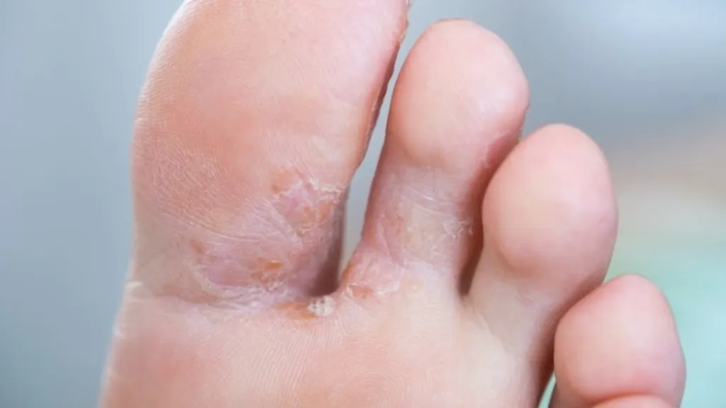 Cara Mengobati Kutu Air di Sela Jari Kaki Sampai Tuntas