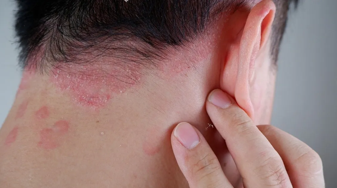 5 Cara Ampuh Atasi Ketombe Jamur Agar Gatal Hilang Tuntas