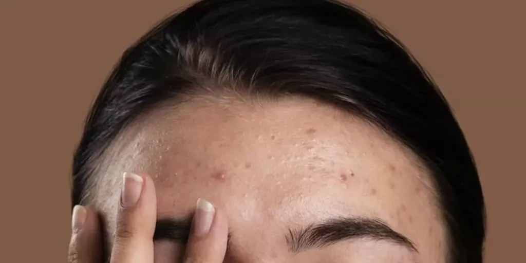 7 Cara Mengatasi Bruntusan di Wajah agar Halus dan Glowing