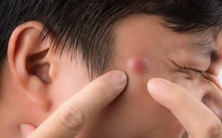 7 Cara Cepat Menyembuhkan Bisul tanpa Bekas Menghitam di Kulit