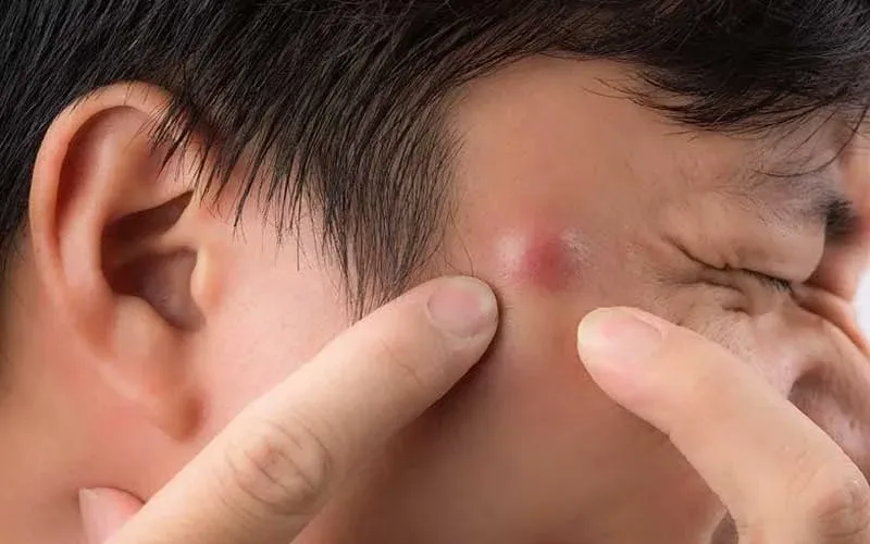 7 Cara Cepat Menyembuhkan Bisul tanpa Bekas Menghitam di Kulit