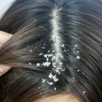 10 Cara Menghilangkan Ketombe Kering yang Ampuh & Cepat