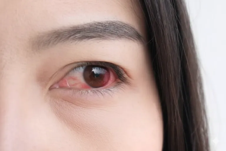 Kenapa Ada Bercak Merah di Mata dan Kapan Perlu ke Dokter?
