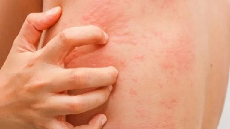 7 Cara Ampuh Menghilangkan Biduran agar Gatal Tidak Muncul Lagi