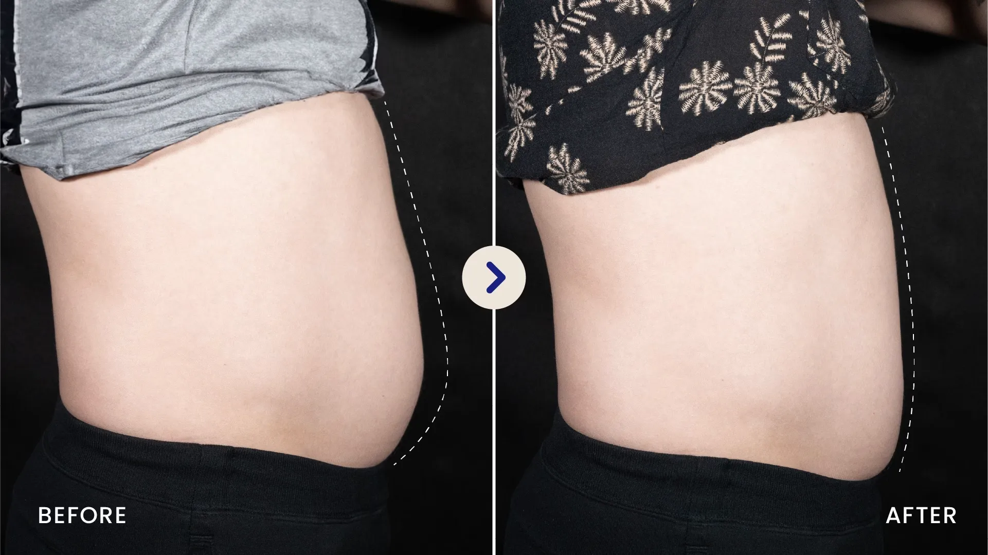 Edukasi dan Hasil Nyata Meso Slimming SOZO Skin Clinic