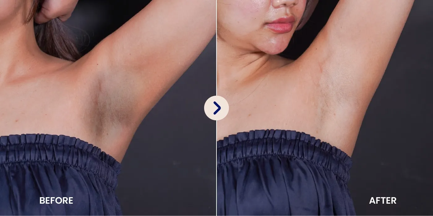 Before After Skin Treatment