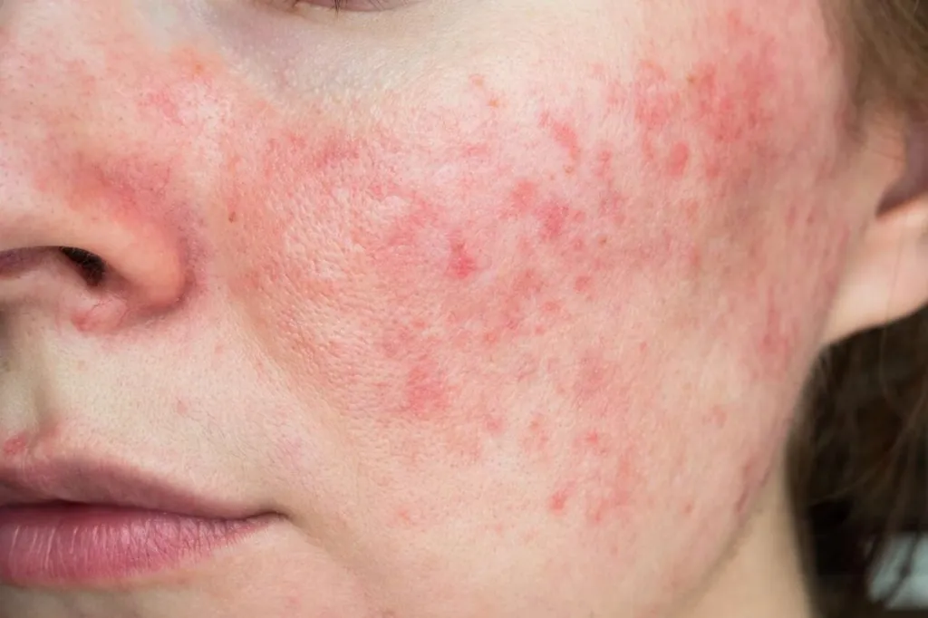 Sering Biduran dan Kulit Sensitif? Cara Menyembuhkan Biduran Tanpa Merusak Skin Barrier