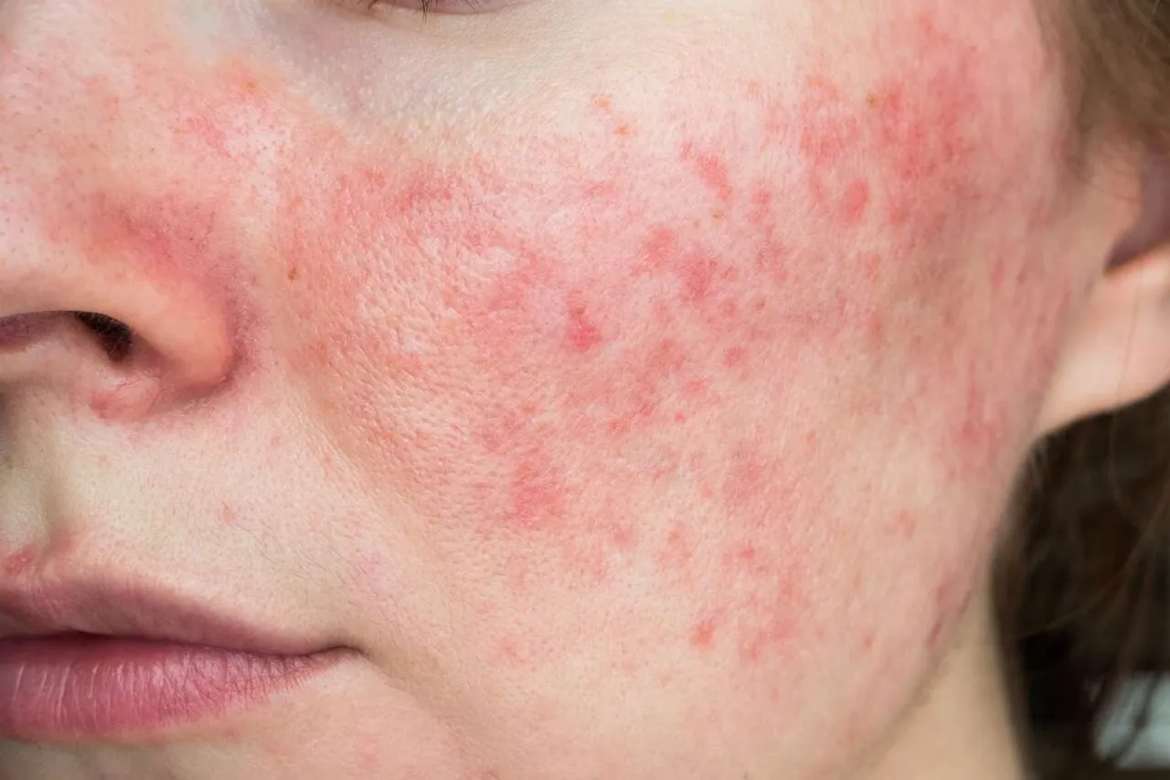 Sering Biduran dan Kulit Sensitif? Cara Menyembuhkan Biduran Tanpa Merusak Skin Barrier