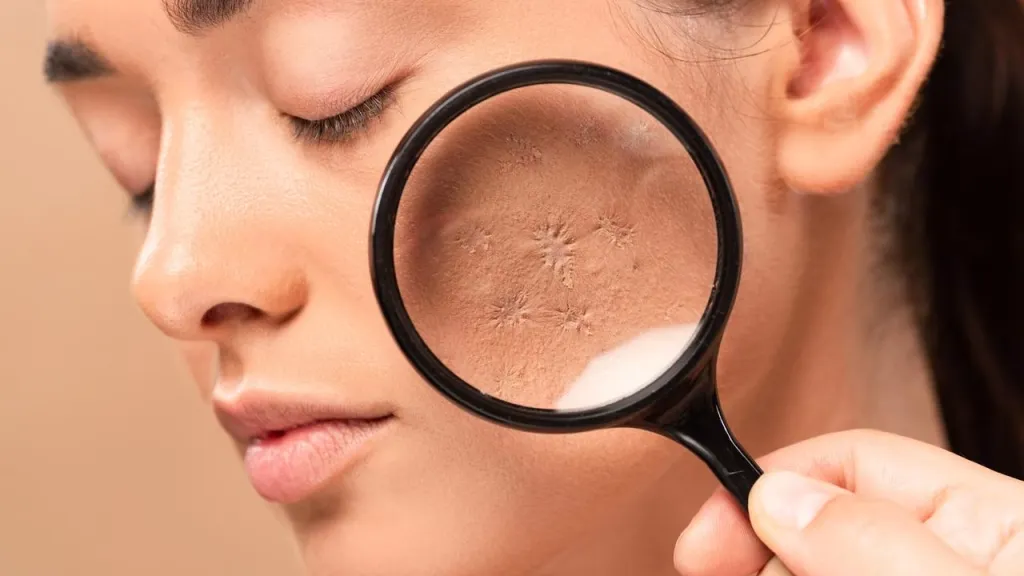 Cara Menghilangkan Bopeng di Pipi dengan Perawatan Tepat di Sozo Skin Clinic