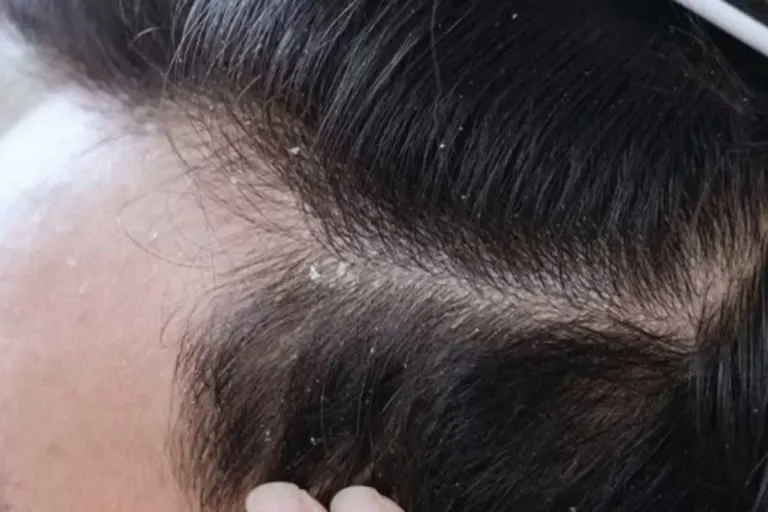 Ketombe Basah Bikin Gatal & Bau? Ini Cara Menghilangkannya