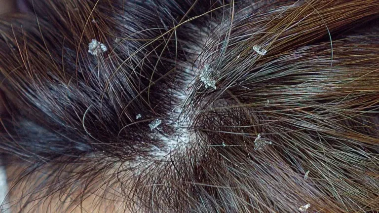Cara Mengatasi Kulit Kepala Kering & Mengelupas dengan Scalp Treatment