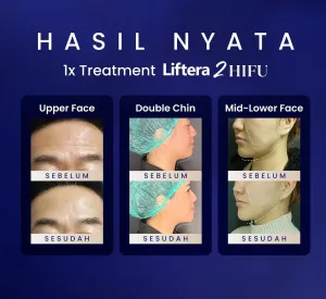Hasil Liftera HIFU di Sozo Skin Clinic