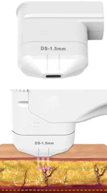 Alat HIFU cartridge 1.5mm