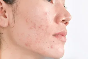 Hiperpigmentasi Pascaperadangan