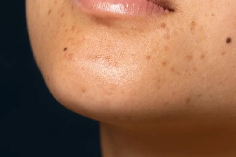 Dark Spot (Hiperpigmentasi): Penyebab, Jenis, dan Cara Mencegahnya