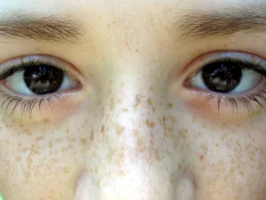 Freckles