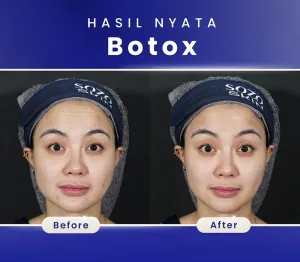 Botox Wajah Before After Sozo Skin Clinic