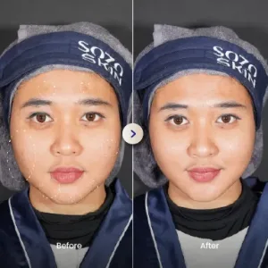 Hasil Laser Treatment Sozo Skin Clinic