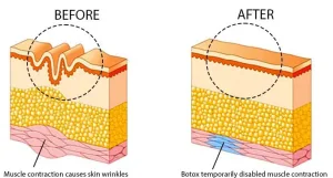 Botox Wajah