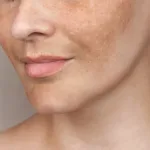 RF Wajah untuk Melasma: Membantu atau Memperburuk?