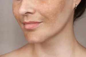 Gambar Melasma