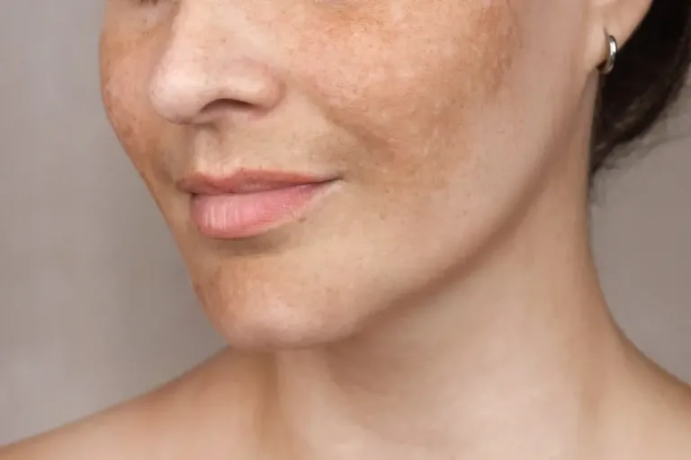 RF Wajah untuk Melasma: Membantu atau Memperburuk?