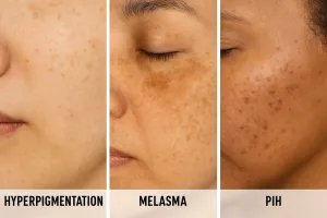 Perbandingan antara Hiperpigmentasi, Melasma dan PIH