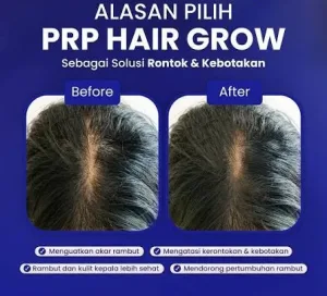 Hasil Before and After PRP Hair Treatment di Sozo Hair