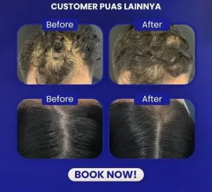 Hasil Before dan After Hair Treatment di Sozo Skin Clinic