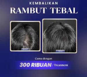 Hasil Hair Treatment Sozo Skin Clinic