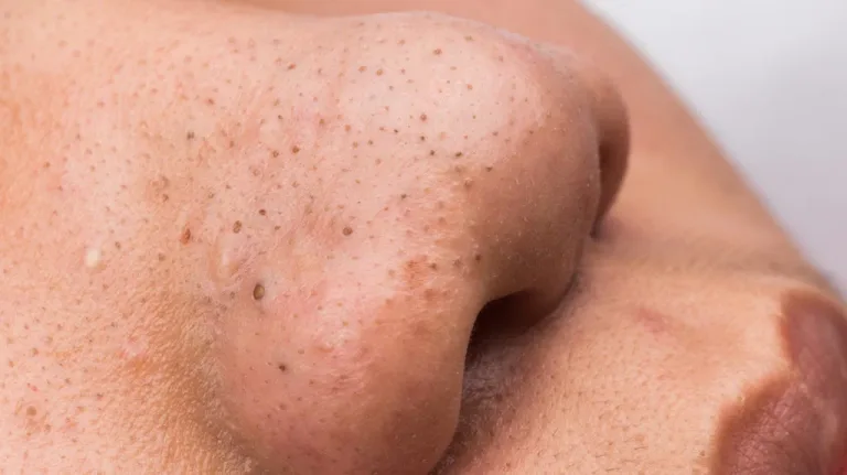 Komedo Hitam di Hidung? Cek Penyebab & Cara Menghilangkannya