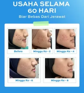 Hasil Acne Treatment Sozo Skin Clinic