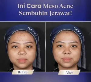 Hasil Meso Acne Treatment Sozo Skin Clinic