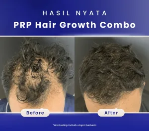 Hasil Before and After PRP Treatment Sozo Skin Clinic