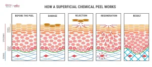 Cara Kerja Chemical Peel