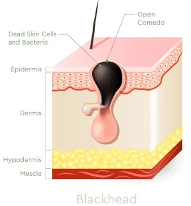 Ilustrasi Komedo Hitam